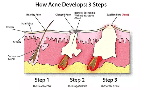 Stages of Acne