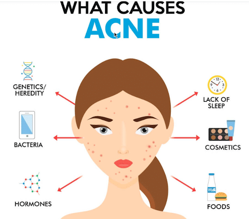 Causes and Treatments for Acne | QuikLaser Skin Treatments Vancouver